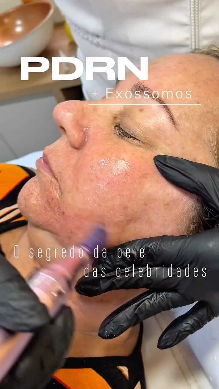 Aplicação de PDRN com exossomos